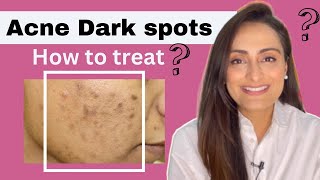 Acne Dark Spots  हिंदी  How to treat  serum cream recommendations  Dermatologist  Dr Aanchal [upl. by Ennirroc]