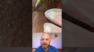 Derm reacts to INSANE ingrown hair extraction dermreacts doctorreacts ingrownhair [upl. by Newo]