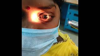 Bilateral dilated pupil not reacting to light due to optic nerve injury [upl. by Occir992]