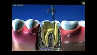 endodontie reconstitution et couronne [upl. by Kcarb]