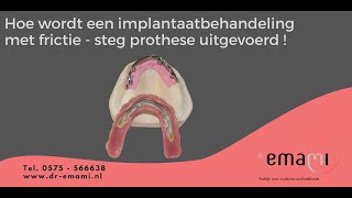 Klikgebitkunstgebitimplantaatfrictie steg prothese [upl. by Gibe]