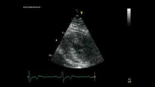 APICAL HYPERTROPHIC CARDIOMYOPATHY  ECHOCARDIOGRAPHY cardiac ultrasound [upl. by Aleahs626]