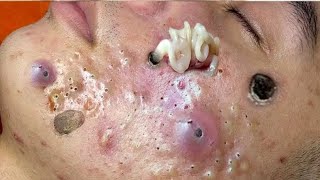 Cleaning Blackheads amp Whiteheads Satisfying Removal463 [upl. by Yrmac]