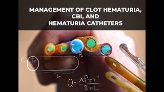 Management of Clot Urinary Retention CBI and hematuria catheters [upl. by Mahseh]