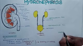 HYDRONEPHROSIS  Pathophysiology Causes signs and symptoms background diagnosis and treatment [upl. by Curnin]