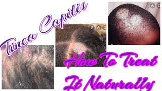 Tinea Capitis How To Treat It Naturally Diagnosedupdatetreatment [upl. by Ahseiym]