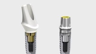 Nobel Biocare Implant Systems [upl. by Sueahccaz113]