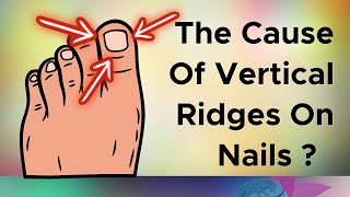 Do You Have Vertical Ridges On Your Nails Cause [upl. by Naegem36]