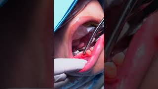 Teeth Extraction Surgery Torrance CA  Torrance Oral Surgery amp Dental Implant Center  Palos Verdes [upl. by Nyliahs697]