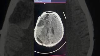 CT Scan Showing Recovery Patient radiology ctscan [upl. by Eanaj]