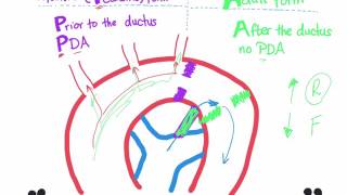 Coarctation of aorta Infantile type vs adult type mnemonic [upl. by Nihahs249]