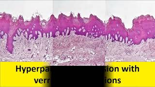 A Case of Proliferative Verrucous Leukoplakia [upl. by Gweneth]