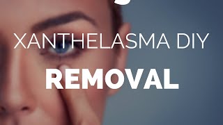 Xanthelasma diy removal easy home removal with Xanthel [upl. by Naihr]