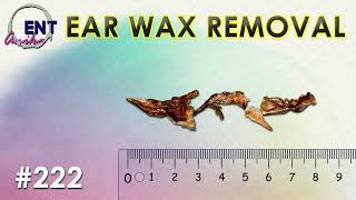 Ear Damage Epidemic Is Earwax or Earbuds to Blame [upl. by Glenine931]