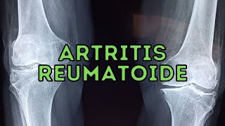 TODO SOBRE Artritis Reumatoide [upl. by Nonad]