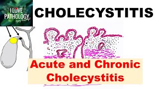 CHOLECYSTITIS Acute and Chronic Pathology and Complications [upl. by Stringer587]