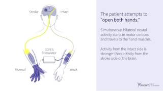 New Post Stroke Electrical Stimulation Therapy [upl. by Ahsiakal]