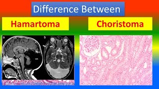 Difference between Hamartoma and choristoma [upl. by Chance684]