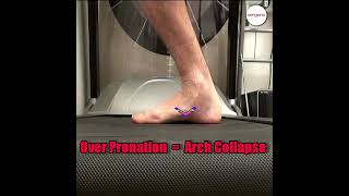 Watch us unveil the link between overpronation arch collapse and foot pain [upl. by Noah]