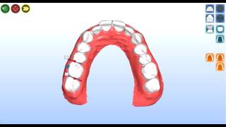 OrthUP demo breve [upl. by Aima]