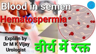 Blood in semen  Hematospermia causes diagnosis treatment in hindi [upl. by Anavoig]