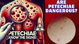 Identify and Treat Petechiae Spotting Serious Health Signals Fast [upl. by Sel]