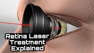 What is it like to get Retinal Laser Eye Surgery done Retina laser barragelaser [upl. by Elspet]