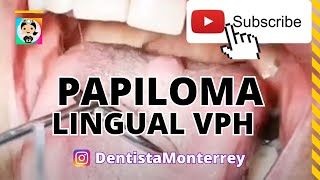 VIRUS DEL PAPILOMA HUANO VPH👅PAPILOMA LINGUAL CAUSAS [upl. by Maitund168]