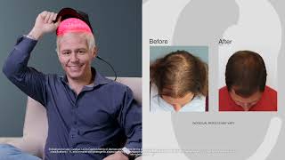 Hair loss no more real men real results with Capillus [upl. by Neil]