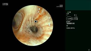 EBUS Needle Fracture  Bronchoscopic retrievel [upl. by Annaeerb]