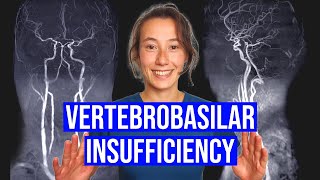 Vertebrobasilar Insufficiency VBI Test [upl. by Vallery481]