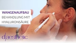 Wangenaufbau  Behandlung mit Hyaluronsäure  daesthetic [upl. by Nortyad]