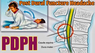 Post Dural Functure Headache  PDPH  Mechanism of PDPH [upl. by Jonah]