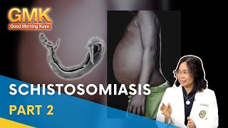 Schistosomiasis Causes Symptoms and Treatment Part 23  Usapang Pangkalusugan [upl. by Roland]