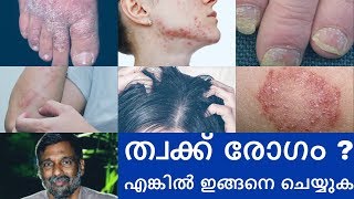 Psoriasis  Skin diseases treatment  Mohanan Vaidyar [upl. by Giovanni49]