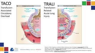 Critical Care TACO and TRALI APSA 2020 [upl. by Eylk]