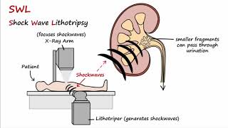 Kidney Stones  Types Formation Treatment Prevention [upl. by Lorelei]