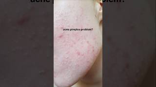 Best pharmacy gel for acne pimples problemsskincareshortsfeed shorts [upl. by Harrow976]