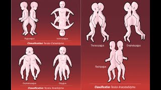 Types of conjoined conjoint twins  Omphalopagus Pygopagus Craniopagus Diprosopus Parapagus [upl. by Broddie]