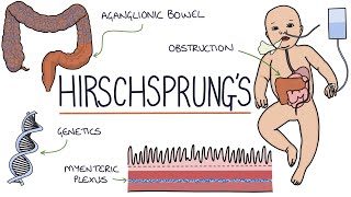 Hirschsprungs Disease [upl. by Monto]