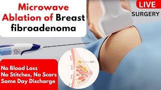 Microwave Ablation of Breast fibroadenoma  Non Surgical Treatment  Without Surgery [upl. by Kayle]