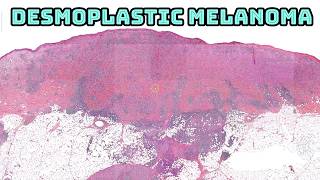 Desmoplastic Melanoma under the microscope pathology dermpath dermatology dermatopathology [upl. by Corvin162]