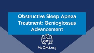 Obstructive Sleep Apnea Treatment Genioglossus Advancement [upl. by Afton94]