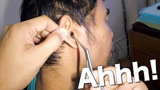 Something White amp Itchy Stuck in Mans Ear Removed  Its An Ear Fungus [upl. by Notsew]