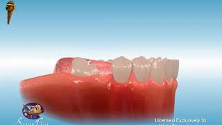 Uprighting Molars [upl. by Etireugram795]