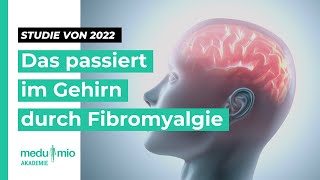 Graue Substanz 🧠 Studie 2022 Das passiert im Gehirn durch Fibromyalgie [upl. by Allmon]