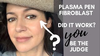 Plasma Fibroblast BEFORE and AFTER [upl. by Illoh]