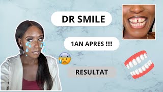 TRAITEMENT DR SMILE 1AN APRÈS JE RÉPONDS À VOS QUESTIONS 😁 [upl. by Babb]