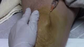 Prolozone Injections [upl. by Furie]