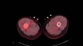 MSK Tumor C9 LCH PET CT [upl. by Segal]